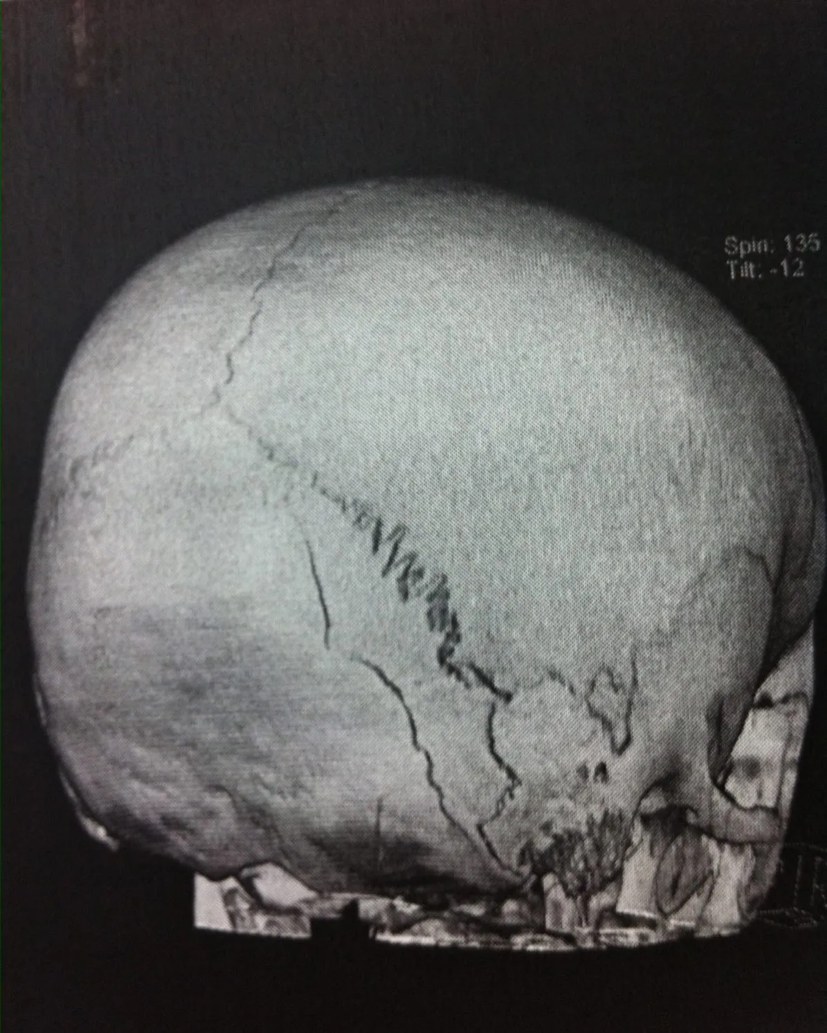 長男が事故で頭蓋骨骨折したときの写真です。